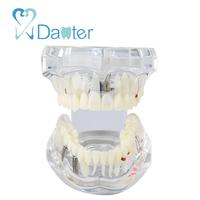 A2001 transparente implante dental modelo Restauración y patologías Dental estudio paciente Modelo de Educación