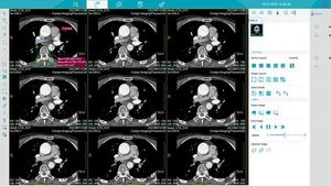MSL High Energy Ray Medical Equipment 32 64 Slice Spiral <span class=keywords><strong>CT</strong></span> Scanner con Cardiac <span class=keywords><strong>CT</strong></span> <span class=keywords><strong>Scan</strong></span> <span class=keywords><strong>Machine</strong></span> Precio - Product Image 5