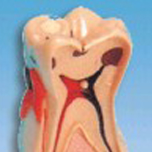 Ada รูปแบบการสลายตัวของฟันทางการแพทย์ขององค์กรและรอยโรคฟันรูปแบบการสลายตัวทางพยาธิวิทยาที่ครอบคลุม - Product Image 3