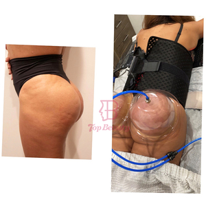 Dẫn LƯU BẠCH HUYẾT vú mở rộng chân không trị liệu mông nâng starvac SP2 thiết bị giảm béo để loại bỏ cellulite - Product Image 3