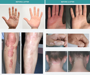 Sistema de Terapia de Luz Excimer KERNEL CN-308P5 de 308nm para el <span class=keywords><strong>Tratamiento</strong></span> del Vitiligo y la Psoriasis con Certificación de EE. UU. y CE - Product Image 2