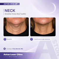 Appareil esthétique professionnel HIIF avec plusieurs profondeurs de traitement pour le soin du visage et du corps, équipement de beauté pour usage en salon