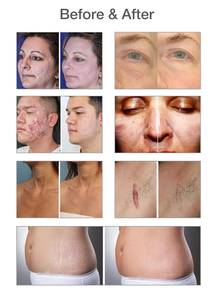 Machine laser CO2 fractionnée 4D portable 10600nm 60W avec système de refroidissement par eau pour le resurfaçage cutané, les vergetures et les cicatrices d'acné - Product Image 6