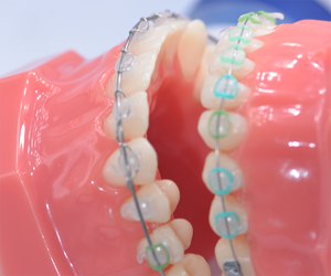 2S ortodontico dentale MBT ceramica staffe auto-leganti con strumento dalla cina - Product Image 6