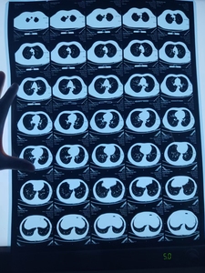 Film bleu d'impression à jet d'encre, taille personnalisée, Image médicale, Film bleu à rayons X PET pour <span class=keywords><strong>imprimante</strong></span> à jet d'encre - Product Image 5