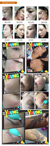 เครื่องเลเซอร์ CO2 แบบพกพาสำหรับลบรอยดำ จุดด่างดำ บำรุงผิว เครื่องมือความงาม - Product Image 6