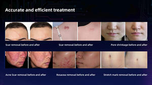 Máquina <span class=keywords><strong>de</strong></span> Rejuvenecimiento Facial con Microagujas RF Fraccionadas No Invasiva, Compatible con EU/US, para Eliminación <span class=keywords><strong>de</strong></span> Estrías - Product Image 6