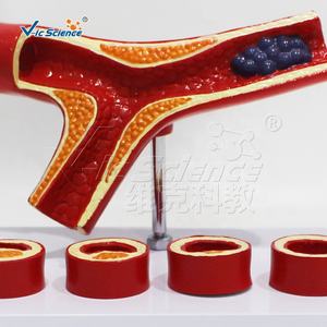 Y-образная модель атеросклероза артерии раздельная модель тромба анатомические модели анатомических моделей сосудов кровеносных сосудов - Product Image 4