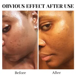 Sabonete preto para remoção de acne, tratamento africano para remoção de manchas escuras e sabonete africano preto