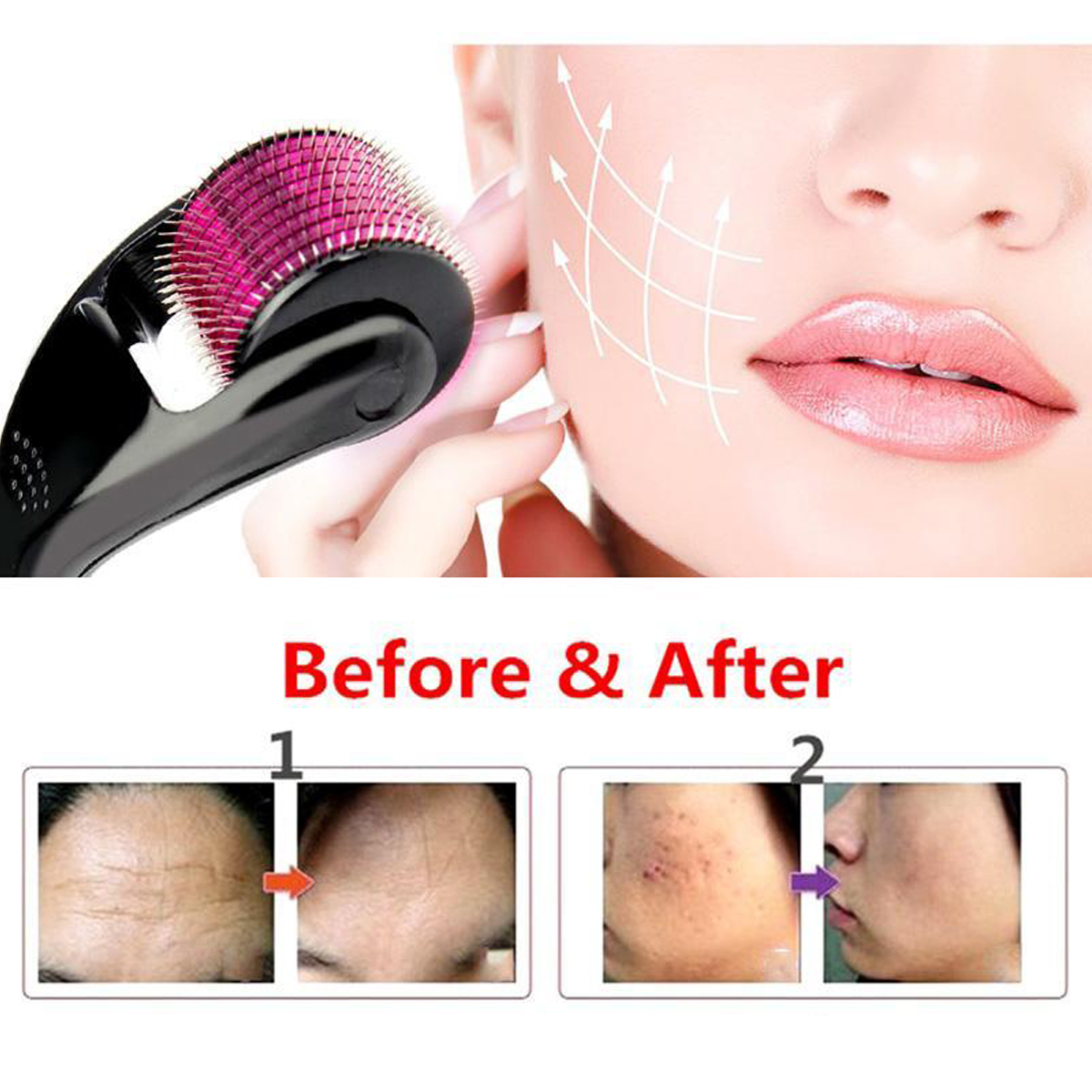 high quality derma roller Best Skin Roller 540 Titanium Micro Needles 0.5mm/1mm/1.5mm Derma Roller