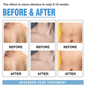 Risenmed Hot Bán Chiều dài y tế Silicone sẹo tấm loại bỏ vết sẹo vá Silicone sẹo Băng - Product Image 3