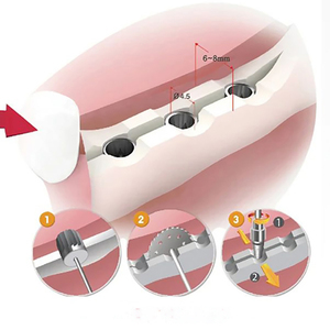 Đi Nụ cười nha khoa ngưng tụ khoan cấy ghép chủ đề hình thành khoan - Product Image 6