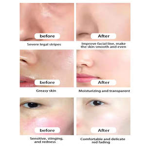 Ensemble de soins de la peau contre l'acné avec logo personnalisé, acide salicylique, hydratant, cosmétiques biologiques végétaliens, kit de soins de la peau pour peaux grasses - Product Image 4