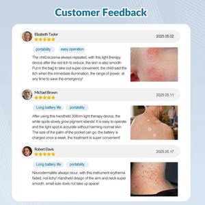 Lámpara de Vitiligo Ultravioleta de 308 nm, Láser B Zjkclasertherapy, Terapia LED, Eczema, <span class=keywords><strong>Dermatitis</strong></span> Atópica, Excimer UVB de 308 nm, 40 Mwcm2 - Product Image 5