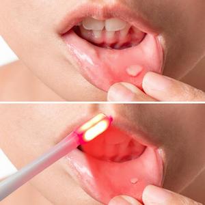 Rotlichttherapie-Lampe Beschleunigt die Heilung von Mundgeschwüren, Reduziert Entzündungen und Verbessert die Zahnfleisch- und Mundgesundheit - Product Image 5