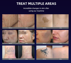 Vitapico Pico-Laser-Gerät Tattooentfernung Nd:YAG Pigmentbehandlung Carbon-Peeling Pikosekunden 755nm Hautverjüngung Medizinischer Laser - Product Image 2