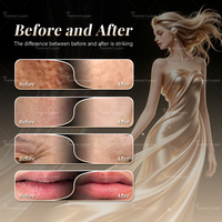 Perfectlaser - Machine de beauté au plasma froid non destructif pour le raffermissement de la peau
