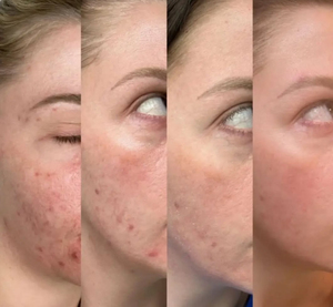S Private Logo Éponge Microneedling Crème & Sérum Réparateur Éponge Spicules Crème Fade Acné <span class=keywords><strong>Cicatrice</strong></span> Tache Sombre Contrôle De L'huile Calme Rougeurs - Product Image 5