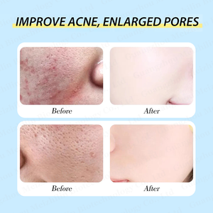 Suero Facial con Ácido Salicílico para Eliminar el Acné, Exfoliante Facial, Suero con <span class=keywords><strong>AHA</strong></span> + Ácido Salicílico - Product Image 4