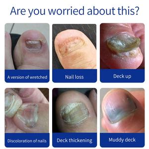 Riparazione <span class=keywords><strong>unghie</strong></span> trattamento liquido <span class=keywords><strong>fungo</strong></span> <span class=keywords><strong>alle</strong></span> erbe trattamento <span class=keywords><strong>unghie</strong></span> Anti <span class=keywords><strong>fungo</strong></span> <span class=keywords><strong>fungo</strong></span> del piede rimuovi Gel <span class=keywords><strong>fungo</strong></span> per <span class=keywords><strong>unghie</strong></span> vendita calda di alta qualità - Product Image 5