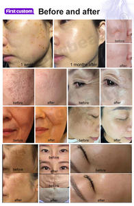 मुँहासे देखभाल पिग्मेंटेशन हटाने और विरोधी भड़काऊ के लिए 10.4 इंच टच स्क्रीन के साथ पोर्टेबल कोल्ड प्लाज्मा मशीन - Product Image 5