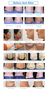 Réduction indolore de la graisse + raffermissement de la peau, massage des tissus profonds + réduction de la graisse, élimination de la <span class=keywords><strong>cellulite</strong></span>. - Product Image 4
