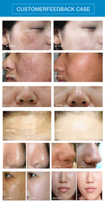 Appareil de soin du visage 4-en-1 à jet d'oxygène, microdermabrasion au diamant, aqua-peeling, écran tactile 7 pouces, hydratation par aspiration - Product Image 6