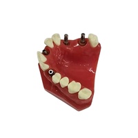Modelo de implante dental: modelo de entrenamiento dental de alta fidelidad para educación y práctica de Implantología