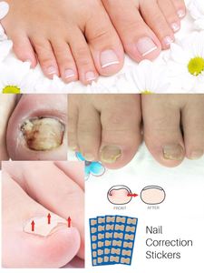 OEM ODM, Autocollant Anti-Curling pour la Correction des Ongles Incarnés, en Tissu Élastique - Product Image 3
