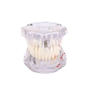 Modelo de Implante Dental, Modelo de Práctica de Restauración Dental - Product Image 2