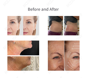 Nouveauté 2025, meilleurs résultats, cryo-amincissement, cryo-tonification, <span class=keywords><strong>appareil</strong></span> Cryoskin Cool Tshock 4.0 - Product Image 6