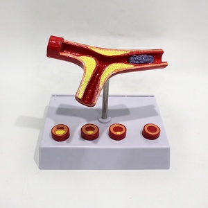 Modelo 3D de Congestión Vascular Bifurcada / Comparación de Estasis Venosa/Arterial por Edad, Entrenamiento de Simulación Médica, Alerta de Riesgo CVD - Product Image 6