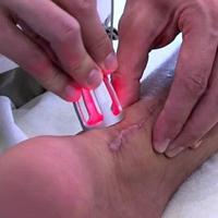 Laser EVLT 980 nm 1470 nm Phlébologie Laser endovénique pour l'élimination des varices et des veines en araignée