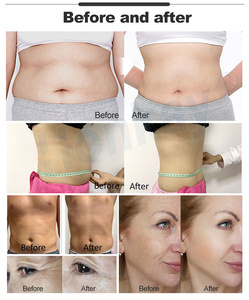 Sistema di Diatermia Tecar RF 448kHz CET RET per Rimozione Cellulite e Rassodamento della Pelle - Product Image 6