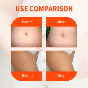 <span class=keywords><strong>Aceite</strong></span> de Masaje <span class=keywords><strong>Regenerador</strong></span> de Piel Corporal Femenino Jaysuing, <span class=keywords><strong>Aceite</strong></span> Hidratante, Reafirmante y Suavizante para <span class=keywords><strong>Cicatrices</strong></span> y Estrías - Product Image 5