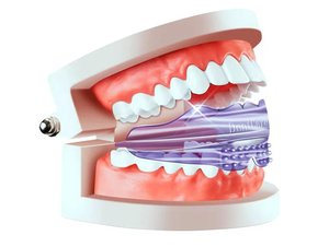 Nuevos Accesorios para Blanqueamiento Dental, <span class=keywords><strong>Alineadores</strong></span> de <span class=keywords><strong>Dientes</strong></span> para Uso Doméstico, <span class=keywords><strong>Alineadores</strong></span> para Entrenamiento de Ortodoncia - Product Image 5