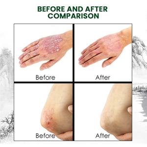 Melhor Multi-Purpose Health Care Pomada para Coceira Relief Psoríase Controle Creme - Product Image 3