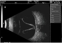 Échographe ophtalmique AIST ODU-5 de Chine, scanner AB pour l'ophtalmologie, excellent prix