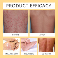 Nouvelle crème contre le psoriasis WiyunHoney, crème au venin d'abeille pour soulager la douleur, convient pour le dos, le cou, les mains, les pieds et les articulations
