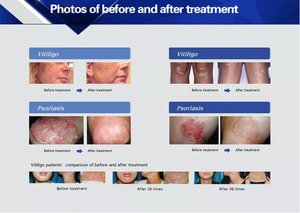Cabina de Fototerapia de Luz UVB de Banda Estrecha de 311nm KERNEL para Tratamiento de Vitígio y Psoriasis - Product Image 5