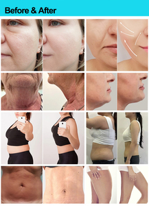 Dispositivo Portátil Multifuncional Onda Coolwave para el Hogar, Tratamiento No Invasivo para la Celulitis, Disolución de Grasa Corporal - Product Image 6