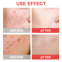 Patchs Hydrocolloïdes Invisibles pour l'Acné – Traitement des Boutons et de l'Acné pour le Visage – Soin de la Peau – Marque Privée