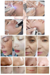 Système de gestion de la peau 9 en 1 : Microdermabrasion, Jet d'oxygène, Lifting et réparation cutanée, Rouleau bipolaire <span class=keywords><strong>HR</strong></span>, Hydratation – Appareil US - Product Image 6