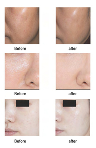 เครื่องดูแลผิวหน้าแบบตั้งโต๊ะพร้อมออกซิเจน สำหรับฟื้นฟูผิวหมองคล้ำ เพิ่มคอลลาเจน และกระชับผิว สำหรับใช้ในสปา - Product Image 5