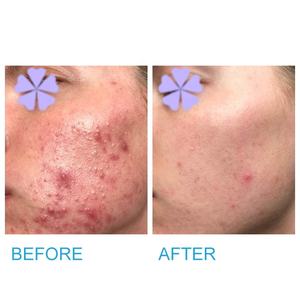 Mousse hydratante et nettoyante pour le visage, produit de soin facial, traitement de l'acné, au peroxyde de benzoïdale, nouveau modèle, - Product Image 6