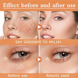 OUHOE - Esencia Facial de 30 ml para Eliminar Grasa y Granos, Tratamiento para Erupciones Cutáneas, Papules y Pústulas, Suero Facial - Product Image 6