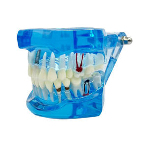 Modèle de réparation bleu école de médecine restauration des nerfs dentaires modèle humain modèle dentaire médical - Product Image 1