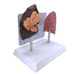 Modelo comparativo para pulmón <span class=keywords><strong>de</strong></span> <span class=keywords><strong>fumador</strong></span> vs equipo educativo <span class=keywords><strong>de</strong></span> pulmón normal - Product Image 5