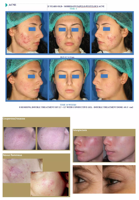 Système de luminothérapie LED PDT vert professionnel pour salon de beauté, traitement facial, 1820 LED, dispositif de beauté LED médical IIa