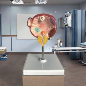 Enfermedades <span class=keywords><strong>de</strong></span> la vejiga y la próstata, modelo <span class=keywords><strong>de</strong></span> anatomía humana médica, patologías del sistema urinario masculino - Product Image 2